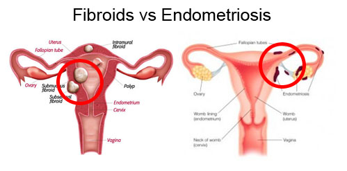 endometriosis vs fibroids fibroid infertility cause uterus uterine difference between cyst fertility leiomyoma questions treatment problems symptoms common choose board