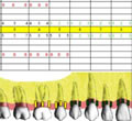 Case study: use of Perioscopy and LANAP for treatment of moderate periodontal disease - Dentristry IQ (08/01/12)