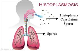 Histoplasmosis Dangers