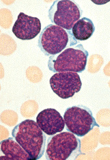 Acute Lymphocytic Leukemia (ALL)
