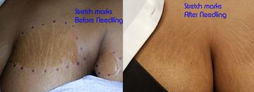 Stretch Marks corrected by Microneedling only